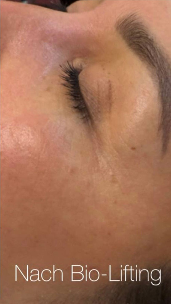 Biofacelifting Anja Haubold