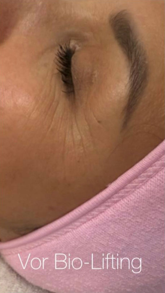 Biofacelifting Anja Haubold