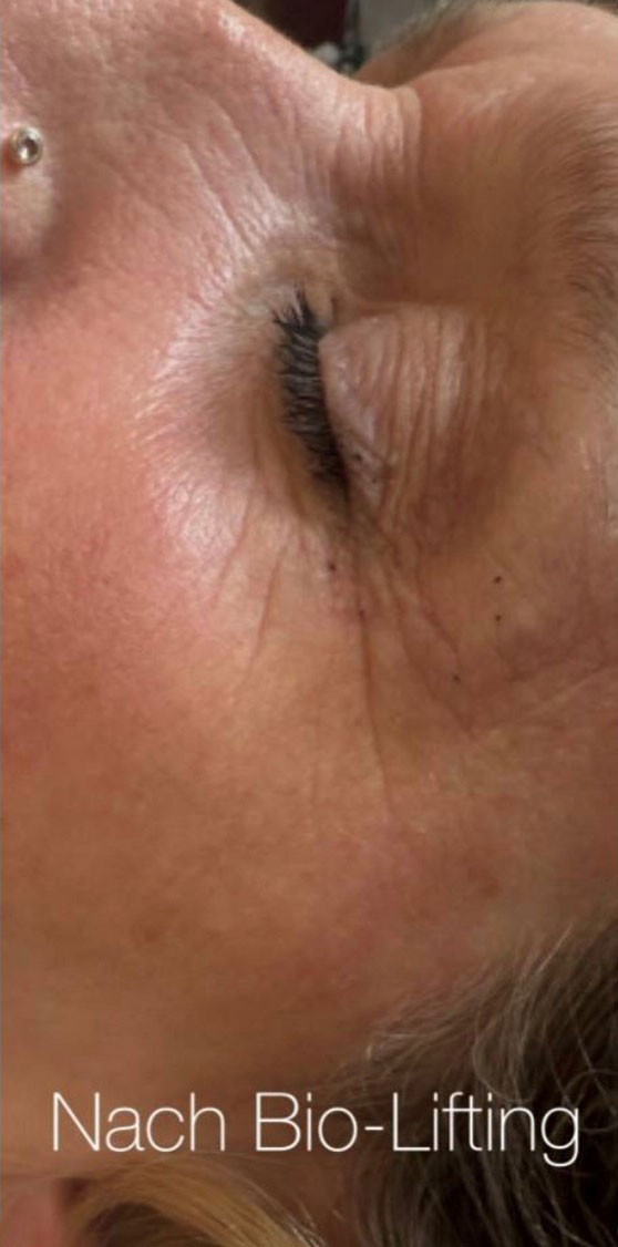 Biofacelifting Anja Haubold